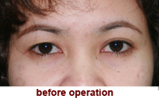 plastic-surgery-blepharoplasty